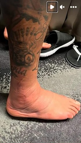 Neymar y la impactante imagen de su tobillo a dos días de su lesión
